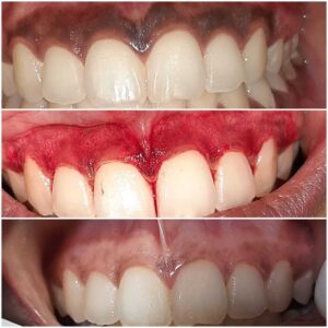 Gum depigmentation